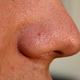 New Acne-Fighting Compound Blocks Inflammation and Kills Bacteria Without Irritating Side Effects